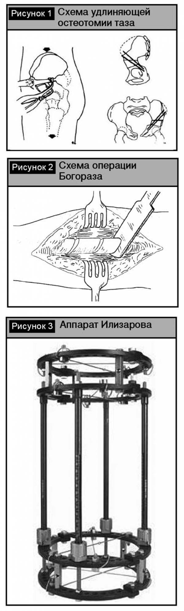 Уравнивание длины нижних конечностей – исторические ракурсы и современные тенденции